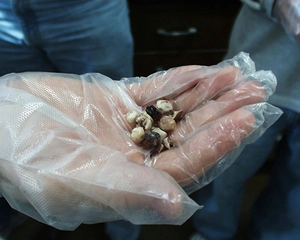 Safra Kesesinde Polip Belirtileri ve Tedavisi